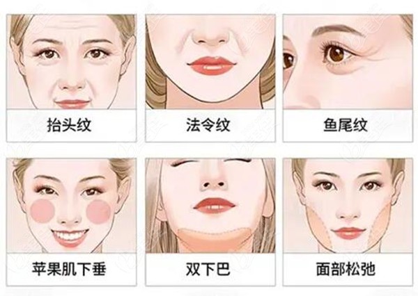 <!--<i data=20240703-sp></i>-->面部拉皮可以解决的问题
