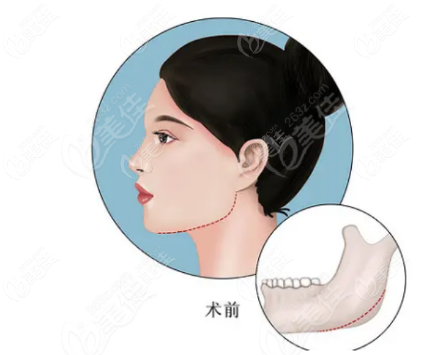 磨骨手术