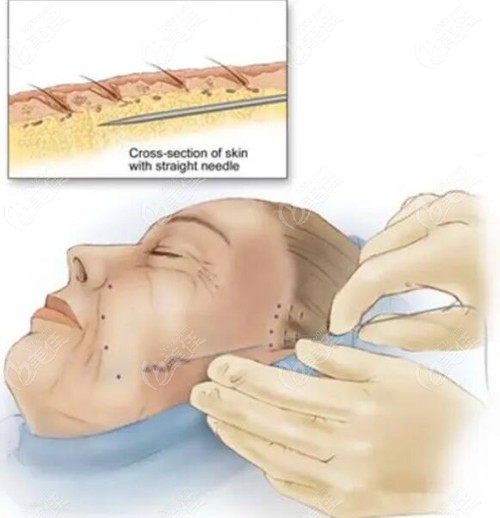 蘭州崔大夫埋線提升的手術(shù)方式