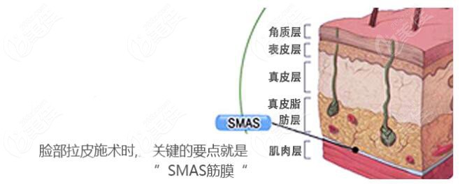 韩国珠儿丽整形的SMAS层除皱
