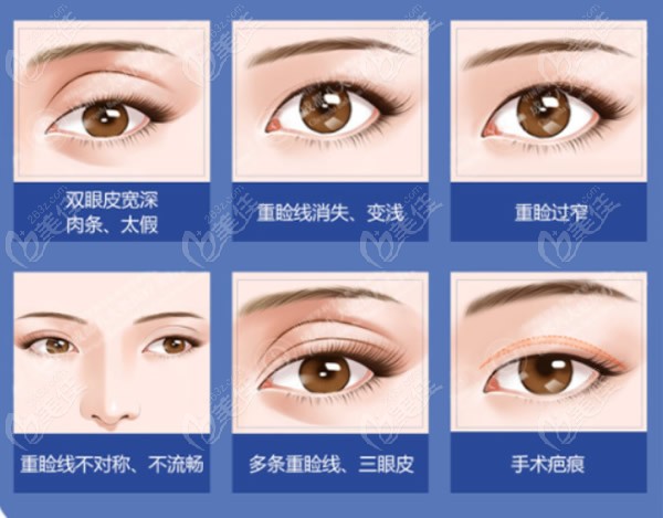上海艺星许炎龙医生图片科普双眼皮失败八种症状有哪些