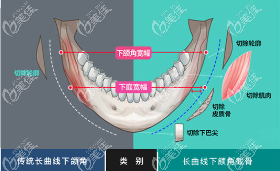 <!--<i data=20240703-sp></i>-->整形医院长曲线下颌角
