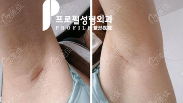 韩国普罗菲耳假体隆胸术后看不出明显疤痕