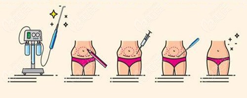腰腹环吸+妈妈臀吸脂过程