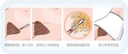 www.236z.com提供的妈妈臀吸脂手术过程