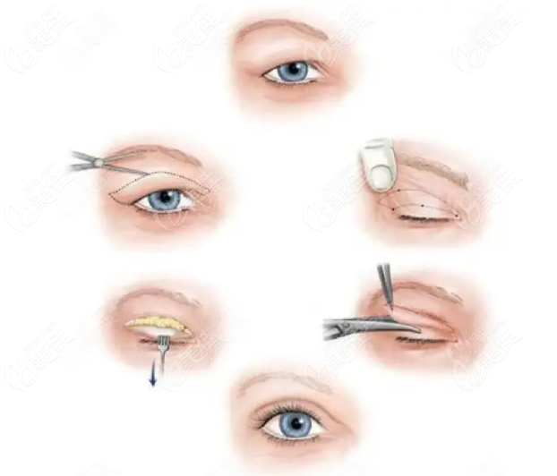 双眼皮手术