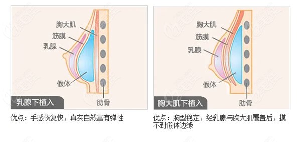 上海美莱乳房假体放置位置