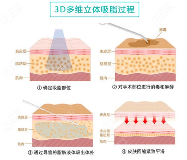 上海美莱多维立体吸脂过程和步骤