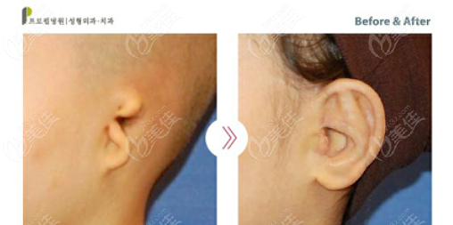 韩国普罗菲耳整形外科耳再造手术
