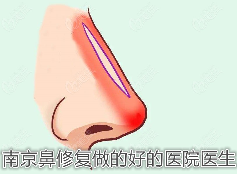 南京鼻修复做的好的医院医生