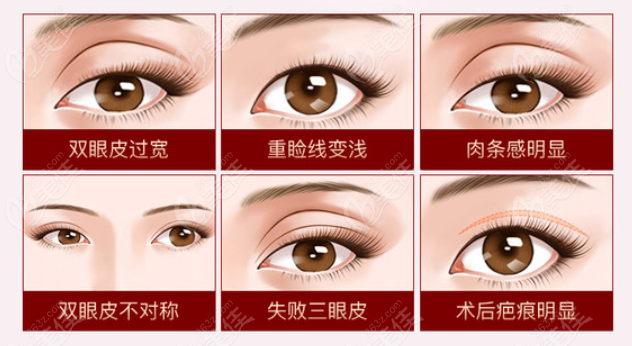 北京双眼皮修复医生排名前十修复双眼皮失败症状