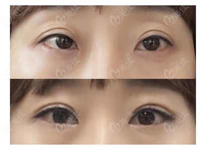 韩国大眼睛眼修复前后对比图