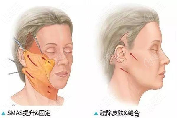 西宁时光拉皮除皱价格