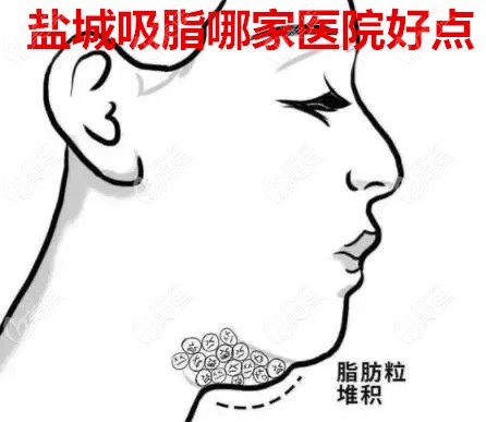 盐城吸脂哪家医院好点