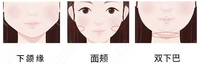 盐城做面部双下巴吸脂好的医院推荐<i data-id='fae8e261-95ef-475e-84e7-2ea306b38e33' style='display:none;'></i>整形