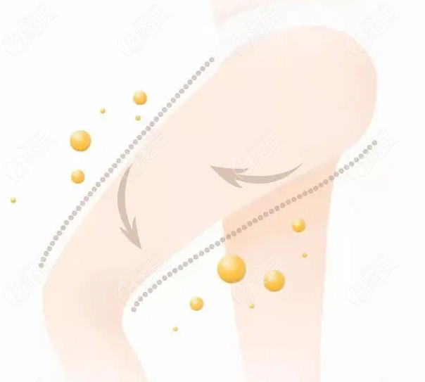 盐城大腿抽脂好的医院是<i data-id='b69693fd-b5c2-4324-99cc-ec3bb48abcb7' style='display:none;'></i>美莉整形