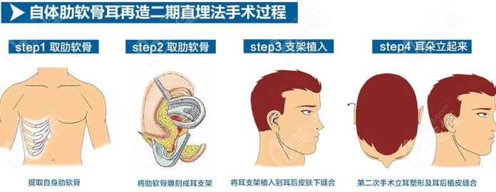 郭志华医生做的完全扩张法耳再造手术过程