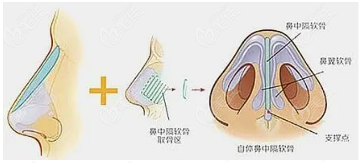 隆鼻手术