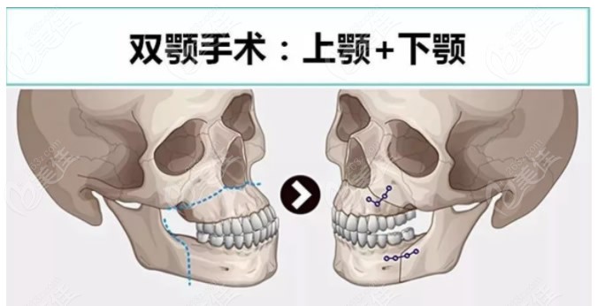 双鄂手术过程图解