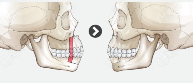 骨性凸嘴正颌手术过程图解