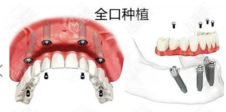 换满口牙大概要多少钱