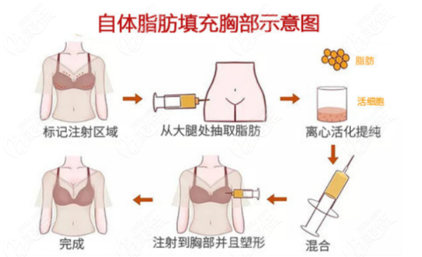 成都脂肪隆胸医生名单推荐