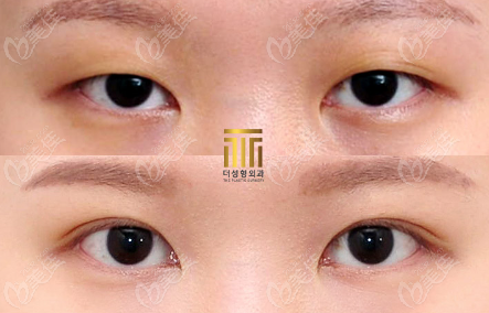 韩国THE整形的提肌双眼皮经恢复过程后前后对比图参考