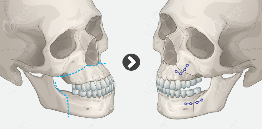双鄂手术能改善面中部脸长吗