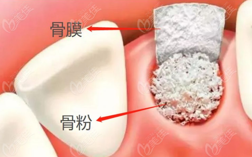 种植牙骨粉和骨膜在什么情况下用？