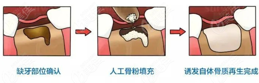 种植牙骨粉和骨膜在什么情况下用？