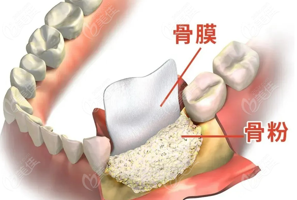 做种植牙为什么要填充骨粉和骨膜？