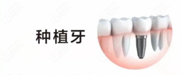 北京西城区牙科种植牙价格