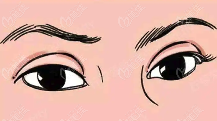 國內(nèi)雙眼皮修復哪家醫(yī)院好