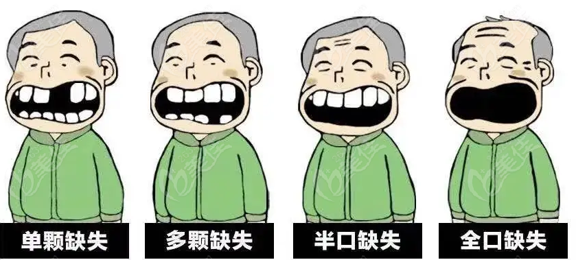 缺牙的各种情况