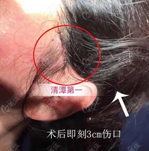 韩国清潭First成镇模拉皮怎么样