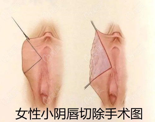 www.236z.com提供的小阴唇切除手术图