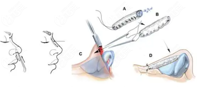 鼻整形手术操作图示