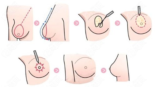 www.236z.com提供的缩胸手术过程图