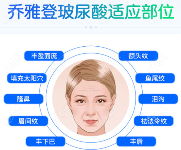 乔雅登丰颜玻尿酸适合填充的部位有哪些