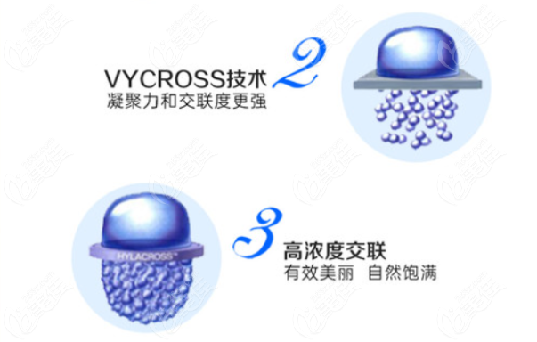 乔雅登丰颜玻尿酸怎么样