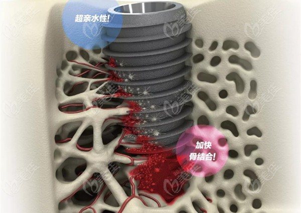种植体的表面处理技术