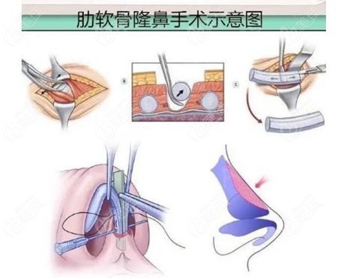 哈尔滨肋骨鼻综合技术图