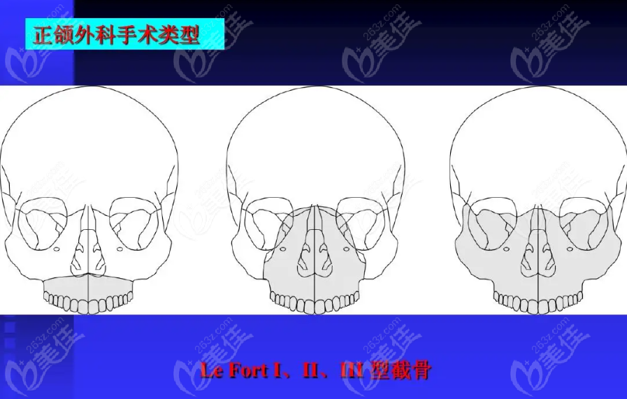 正颌手术lefort I型、II型、III型截骨图示