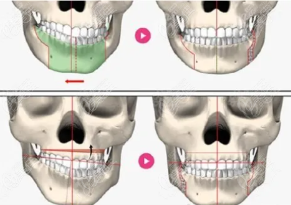 偏颌正颌手术矫正图示