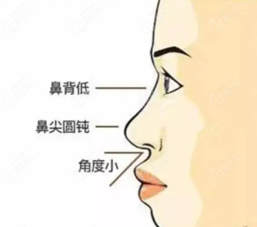 鼻夹板戴越久越鼻子越受影响