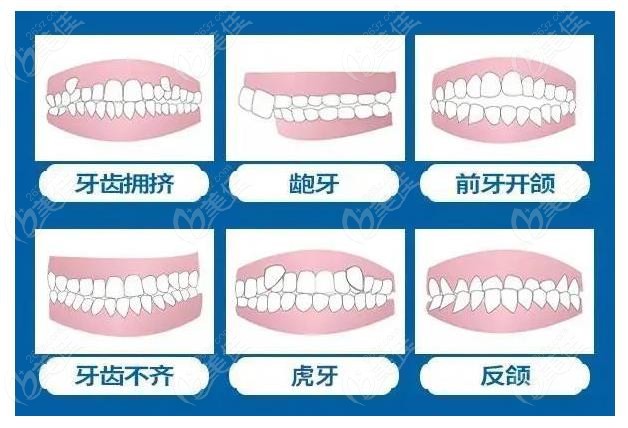 成都牙齿矫正哪家医院性价比高