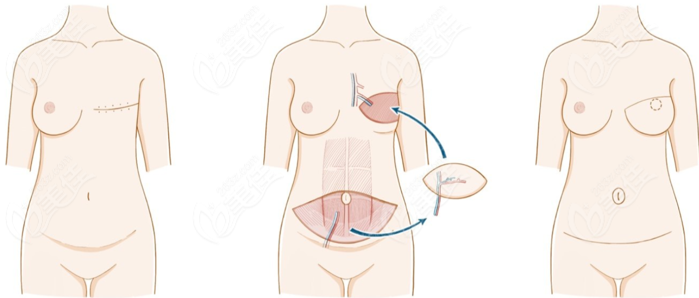 自体皮瓣组织diep乳房重建术过程