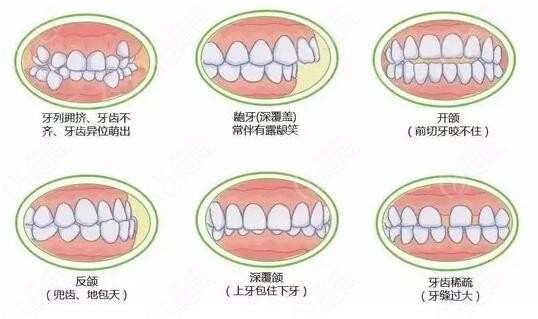 北京禾禾张栋梁医生矫正牙齿怎么样