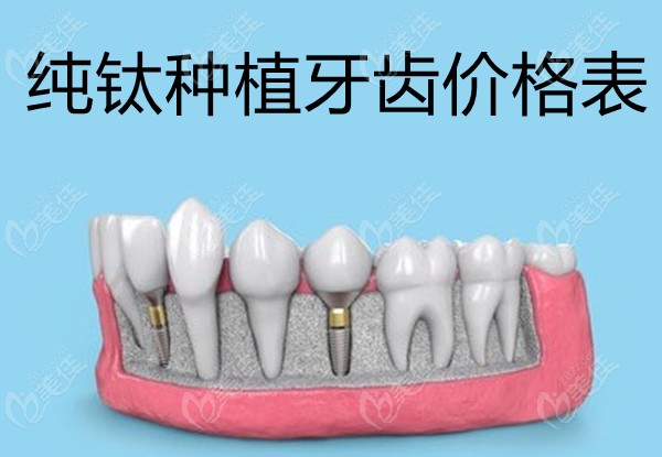 纯钛种植牙齿价格表