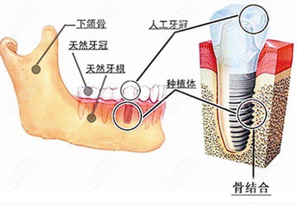 种植牙在牙槽骨内的图